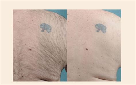 Does Laser Hair Removal Affect Tattoos