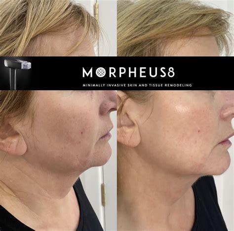 Morpheus8: The Ultimate Skin Tightening Solution Revealed in 10 Words!