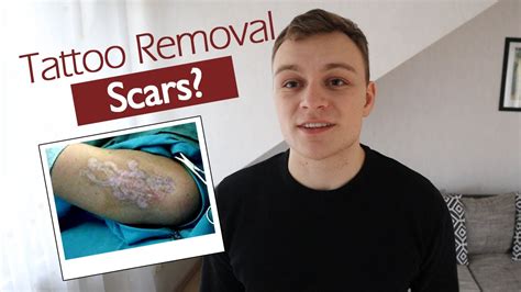 Does Removing Tattoo Leave Scar