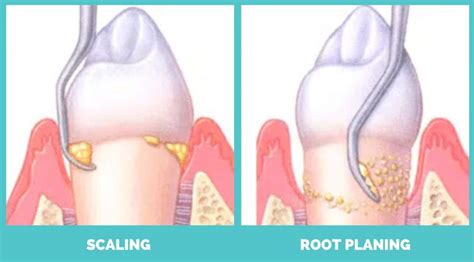 Does Root Planing Hurt