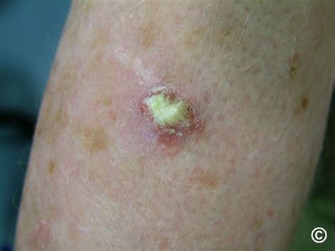 Can Skin Cancer Cause Pus? Unveiling the Truth