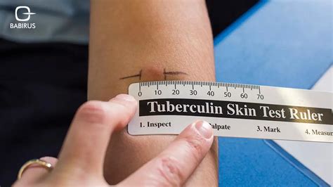 Pain-free TB skin test: a myth or reality?