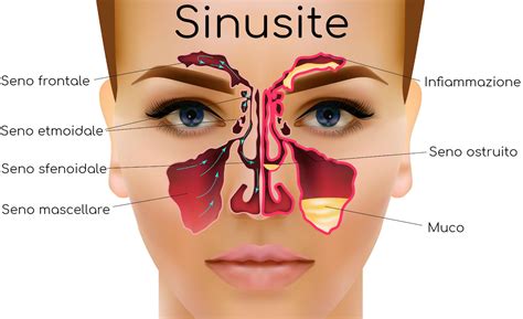 Sinusite sintomi, mal di testa, cura e rimedi Valori Normali