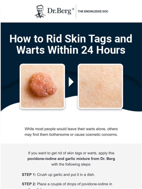 Unravel the Mysteries of Skin Tags with Dr. Berg's Revolutionary Tips and Tricks for Flawless, Glowing Skin!