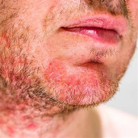 Dry Flaky Skin Under Beard