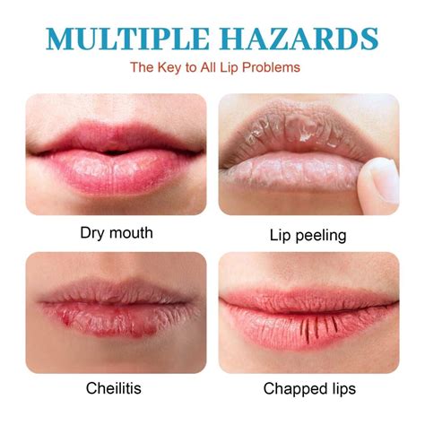 Dry Lips: Hidden Causes & Quick Fixes
