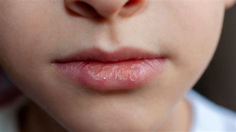 Dry Lips in Kids: Simple Relief Tips