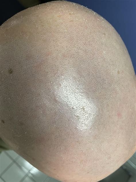 Unveiling the Truth Behind Razor Burn: Discover How to Banish the Pesky Dry Skin After Shaving