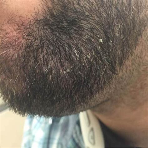 Dry Skin Under Beard