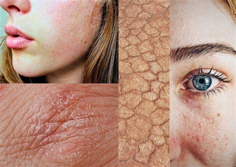 Dry and Sensitive Skin