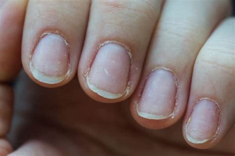 Dry skin and brittle nails