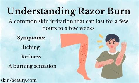 Duration of razor burn image