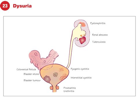Dysuria Relief: 6 Simple & Effective Ways.