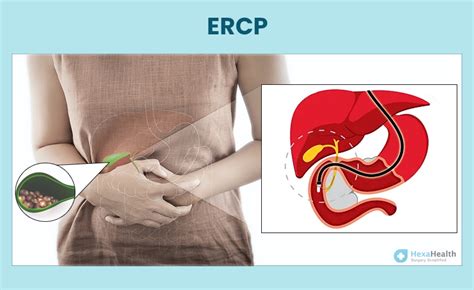 ERCP: Relief, Recovery, & What to Expect.