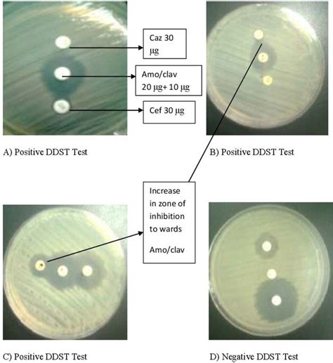 ESBL Detection Test and interpretation