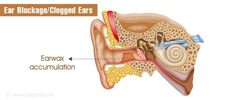 Ear Blockage: Causes & Effective Medicine Solutions