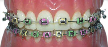 Easter Braces Colors
