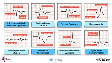 Schemes set of common electrocardiogram (ECG) abnormalities, including