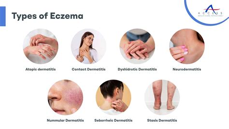 Eczema & Dermatitis: Best Treatments for Relief.