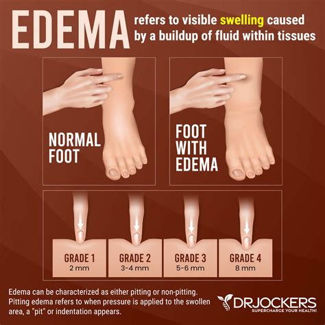 Edema Relief: Causes & Effective Treatments