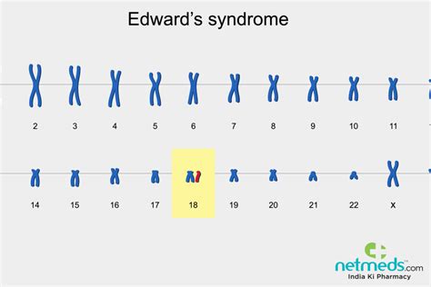 Edwards Syndrome: Causes, Types & What to Know.
