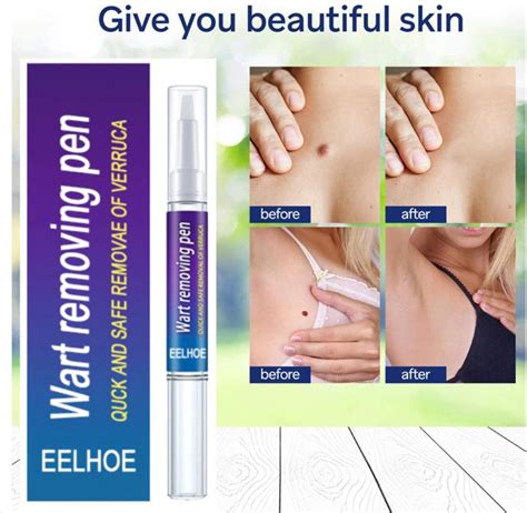 Unveiling the Wonder of Eelhoe Skin Tag Remover: A Comprehensive Review