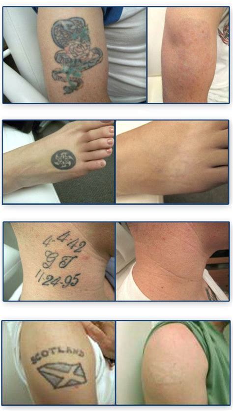 Before & After Tattoo Removal After One Session
