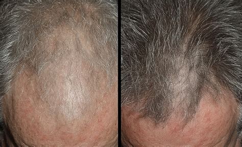 Effectiveness Minoxidil Work