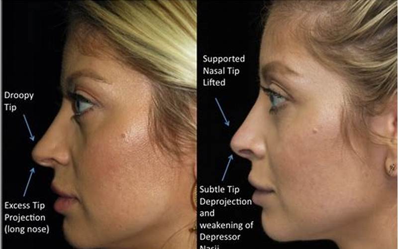 Effects Of Droopy Nose Tip