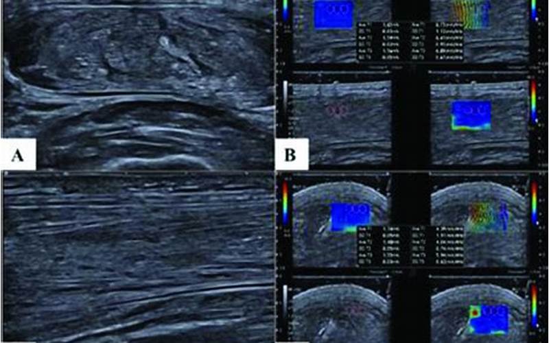 Elastography: Assessing Tissue Stiffness For Disease Diagnosis