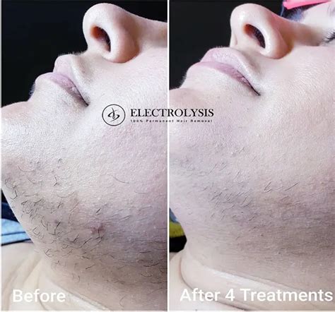 Electrolysis—The Only True Permanent Hair Solution