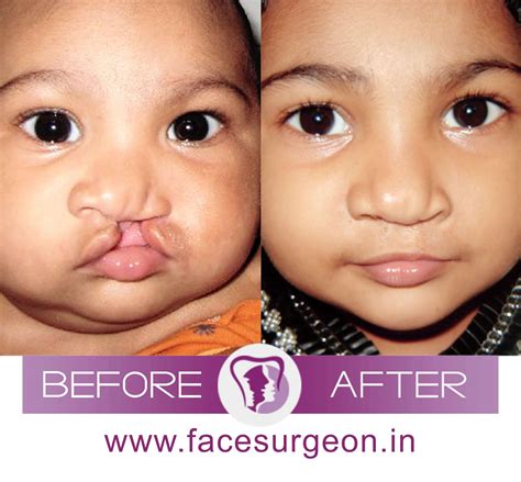 Emergency Cleft Nose Repair