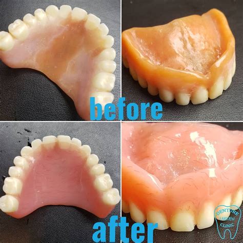 Emergency Denture Repair