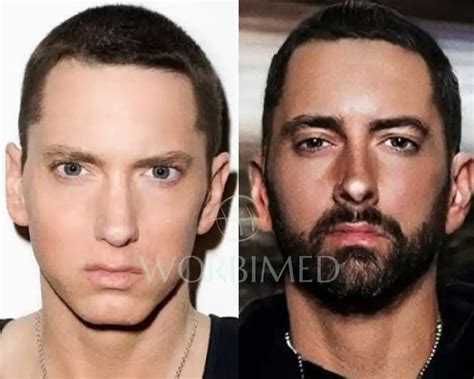 Eminem Beard Transplantation