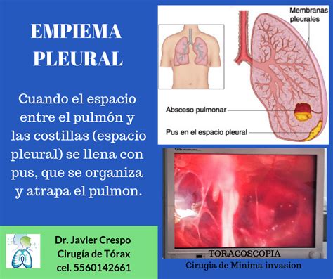 CONOCE LA EMPIEMA CAUSAS,TRATAMIENTO Y COMPLICACIONES