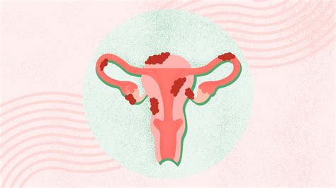 Endometriosis & Pregnancy: Hopeful Paths to Motherhood.