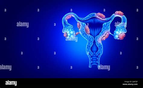 Endometriosis 3D Model: Anatomy for Learning