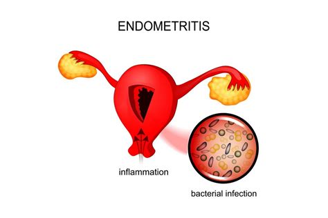 Chronic Endometritis Causes, Symptoms, Home Remedies STD.GOV Blog