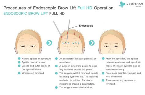 Endoscopic Brow Lift