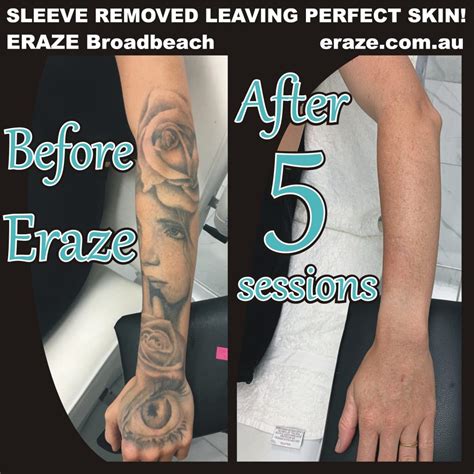 Erase Tattoo Removal The Benefits of Getting Laser Tattoo