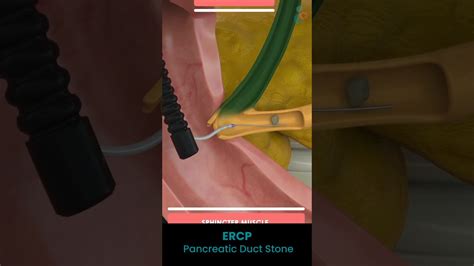 Ercp With Stent Removal Cpt Code