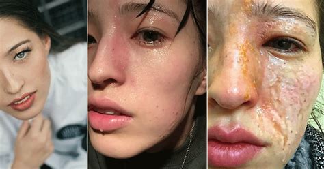 Unlocking the Secret of Essential Oil Elixir: Heal Your Skin Burn with a Powerful Natural Remedy