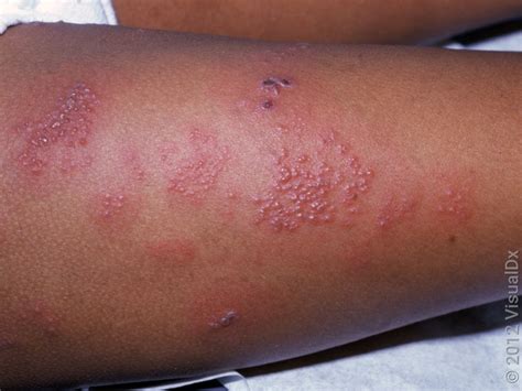 Essential Treatment Steps for Lower Extremity Shingles