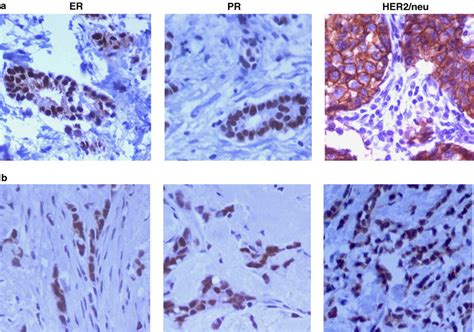 Estrogen Receptor IHC Test and interpretation
