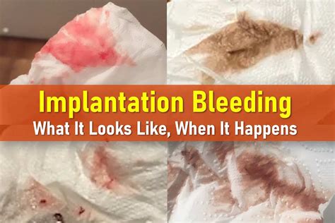 Example Of Implantation Bleeding