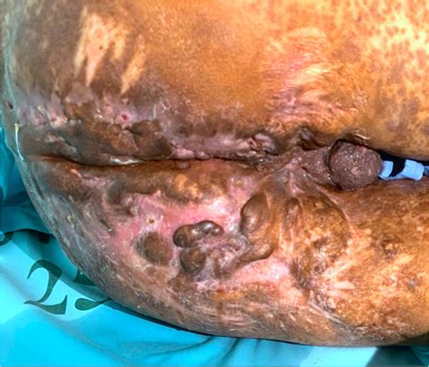 Unveiling the Raw Truth: A Comprehensive Guide to Excoriation of Perianal Skin