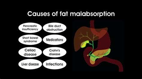 Exercise and Fat Malabsorption