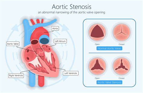 Exercise and Fitness Aortic Stenosis