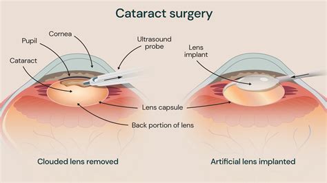 Expert Cataract Removal