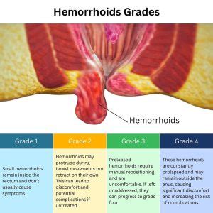 Bid Farewell to Hemorrhoidal Skin Tags: Tips to Get Rid of Extra Skin from Hemorrhoids